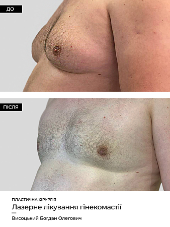 Гинекомастия 43 фото до и после процедуры