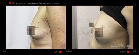 Липофилинг груди фото до и после процедуры
