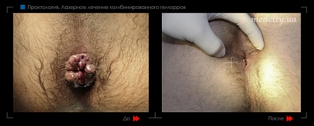 Удаление геморроя лазером 3 фото до и после процедуры