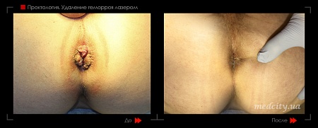 Удаление геморроя лазером 20 фото до и после процедуры