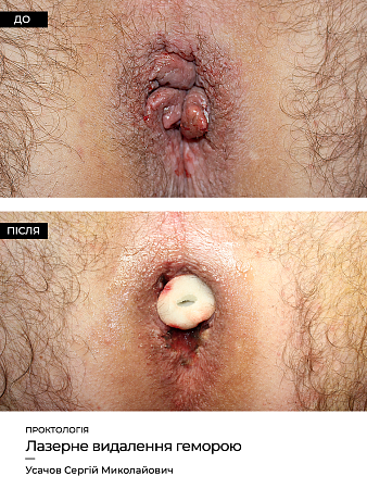 Lechenie gemorroya 1 фото до и после процедуры