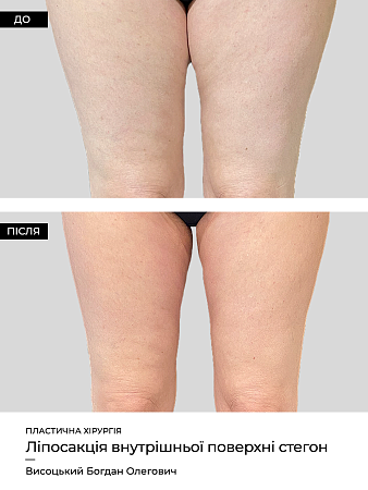 Лазерный липолиз бедер фото до и после процедуры