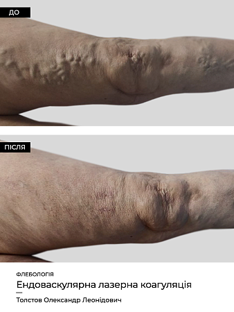 Эндоваскулярная лазерная коагуляция8 фото до и после процедуры