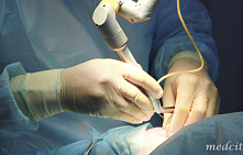 Лечение кондилом у мужчин