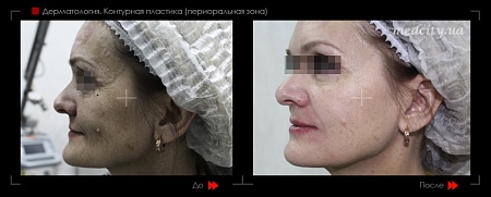 Контурная пластика периоральной зоны 6 фото до и после процедуры