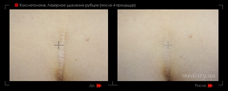 Шлифовка рубца 10 фото до и после процедуры