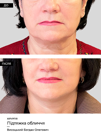 Подтяжка лица 4 фото до и после процедуры