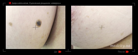 Удаление родинок 68 фото до и после процедуры