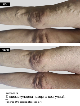 Эндоваскулярная лазерная коагуляция7 фото до и после процедуры