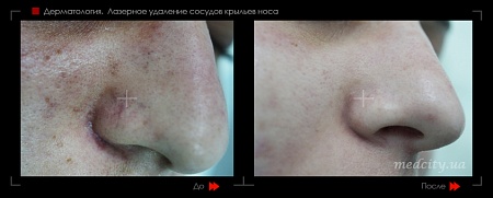 Лазерное удаление сосудов 5 фото до и после процедуры