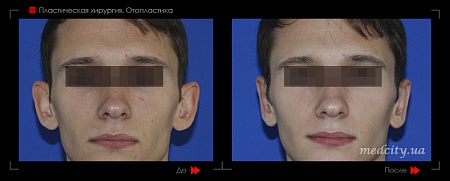 Отопластика 22 фото до и после процедуры