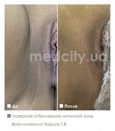 Лазерное отбеливание интимной зоны фото до и после процедуры