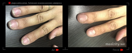 Лазерное лечения грибка 3 фото до и после процедуры