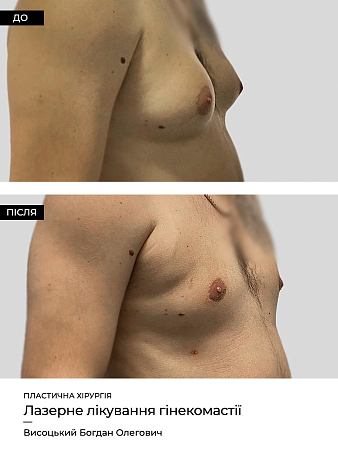 Гинекомастия фото до и после процедуры