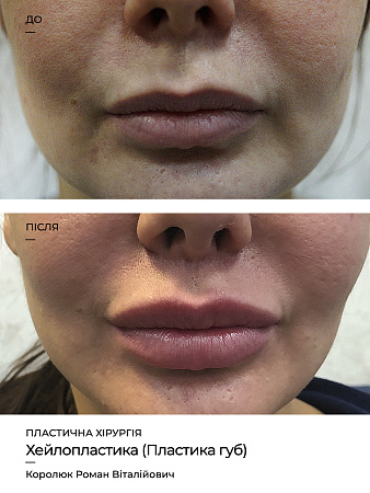Хейлопластика (Пластика губ) фото до и после процедуры