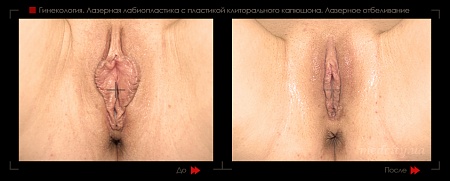 Лабиопластика 46 фото до и после процедуры