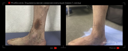 Эндоваскулярная лазерная коагуляция2 фото до и после процедуры