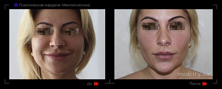 Ментопластика 3 фото до и после процедуры