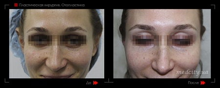 Отопластика 5 фото до и после процедуры