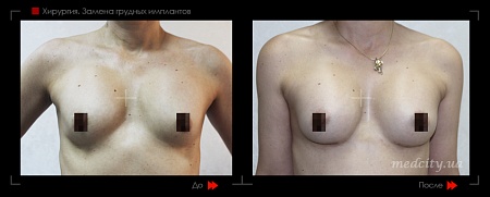 Замена грудных имплантов фото до и после процедуры