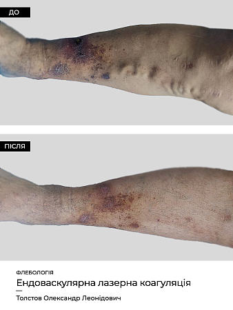 Эндоваскулярная лазерная коагуляция4 фото до и после процедуры