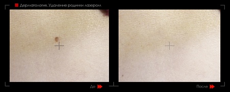 Удаление родинок 53 фото до и после процедуры