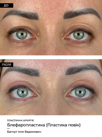 Blefaroplastika 6 фото до и после процедуры