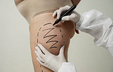 Феморопластика