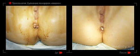Удаление геморроя лазером 9 фото до и после процедуры