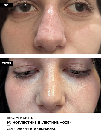 Ринопластика 20 фото до и после процедуры