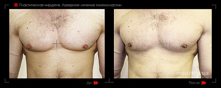 Гинекомастия 40 фото до и после процедуры