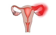 Воспаление придатков у женщин
