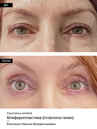 Блефаропластика фото до и после процедуры