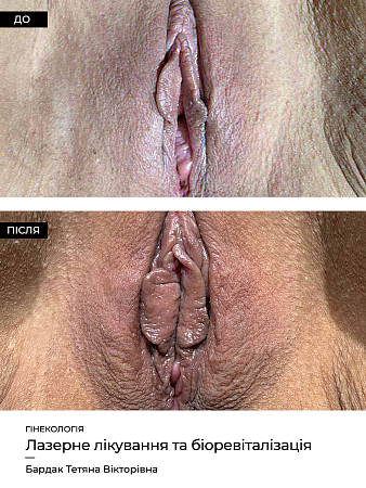 Лазерне лікування в гінекології фото до и после процедуры