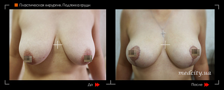 Подтяжка груди фото до и после процедуры