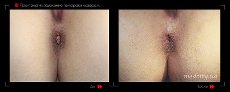 Удаление геморроя лазером 14 фото до и после процедуры