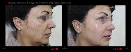 Контурная пластика периоральной зоны 2 фото до и после процедуры