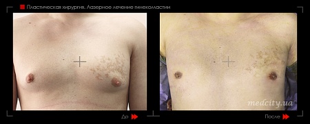 Гинекомастия 33 фото до и после процедуры
