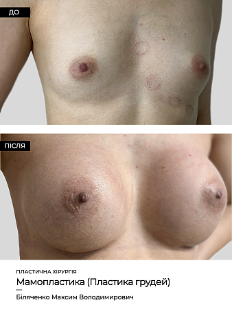 Маммопластика 26 фото до и после процедуры