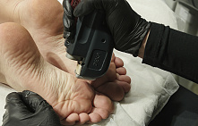 Видалення мозолів лазером