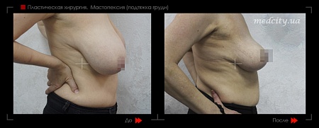 Мастопексия 4 фото до и после процедуры