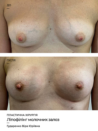 Ліпофілінг грудей фото до и после процедуры