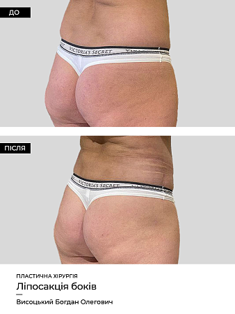 Лазерный липолиз тела 9 фото до и после процедуры