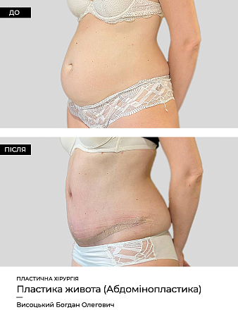 Пластика живота фото до и после процедуры