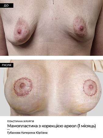 Маммопластика 21 фото до и после процедуры