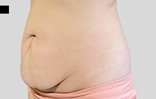 Пластика живота после родов