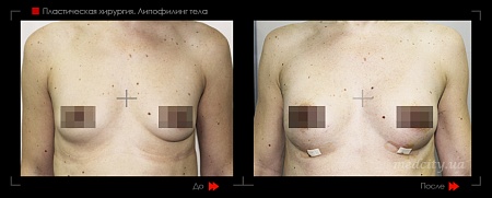 Липофилинг груди-4 фото до и после процедуры