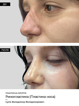 Ринопластика 10 фото до и после процедуры