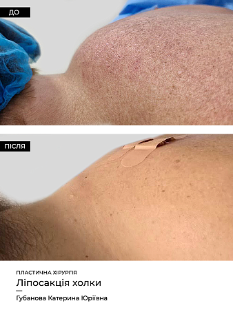 Удаление вдовьего горба  фото до и после процедуры