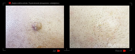 Удаление родинок 65 фото до и после процедуры